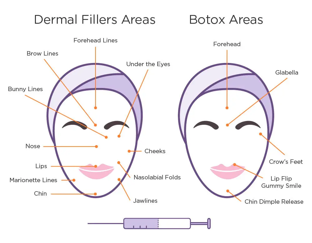 A diagram of the dermal fillers and botox areas.