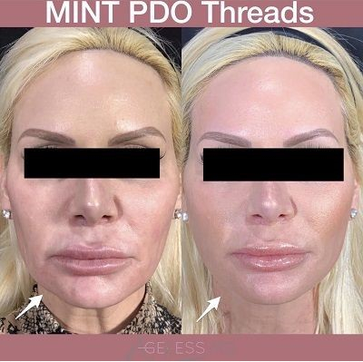A woman with a plastic surgery look has been given the mint pdo threads.